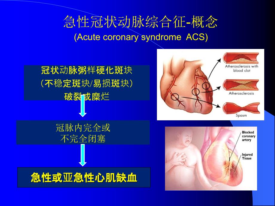 acs危险分层和治疗策略_第4页