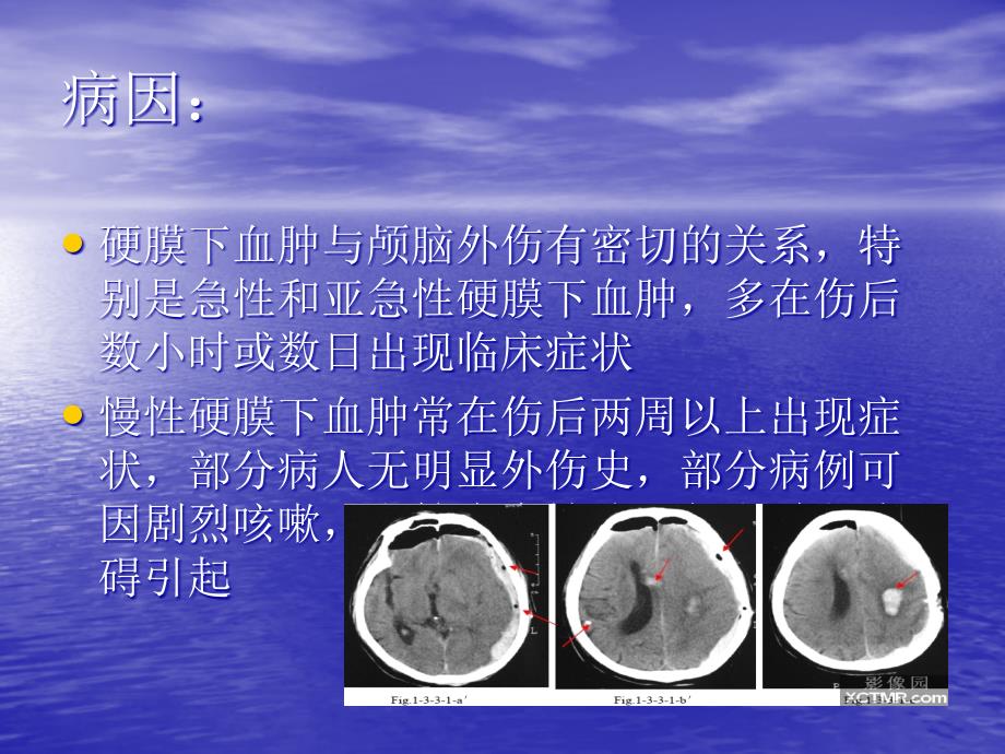 硬膜下血肿的护理_查房_第4页