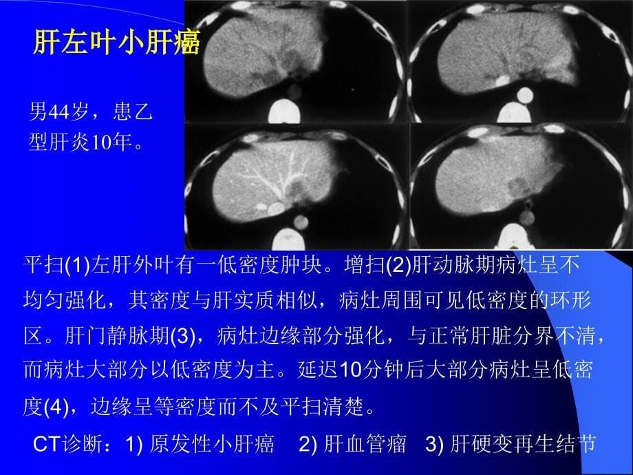 肝脏扫描ppt._第5页