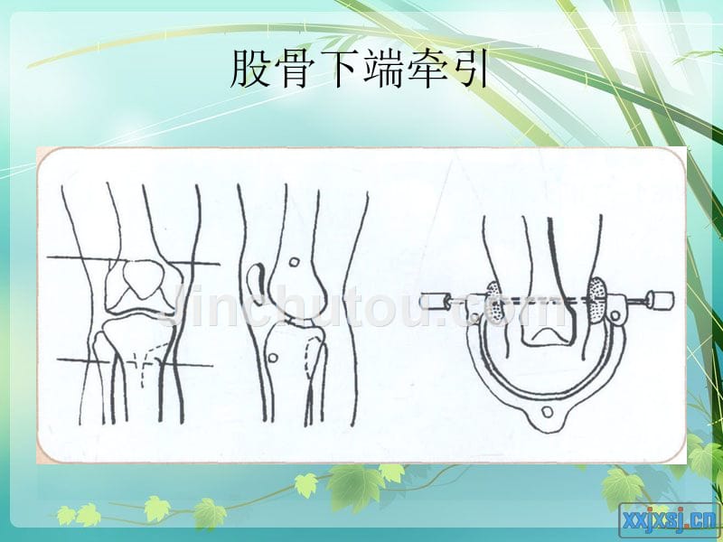 骨牵引病人的护理1[1]讲述_第4页