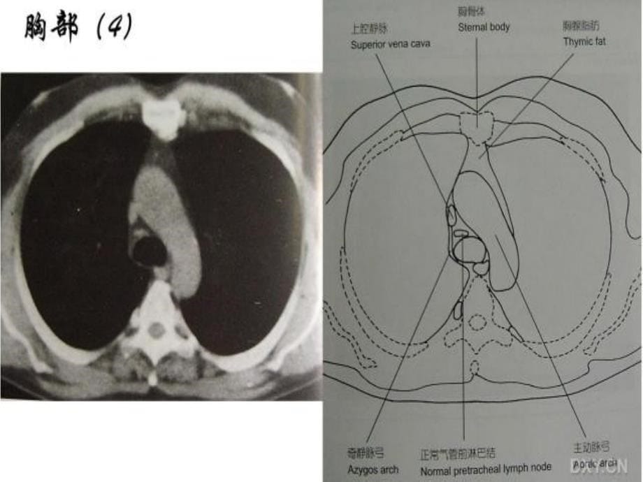 正常胸部ct解剖袖珍图谱课件_第5页