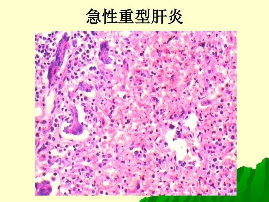 四炎症的组织学类型_第5页