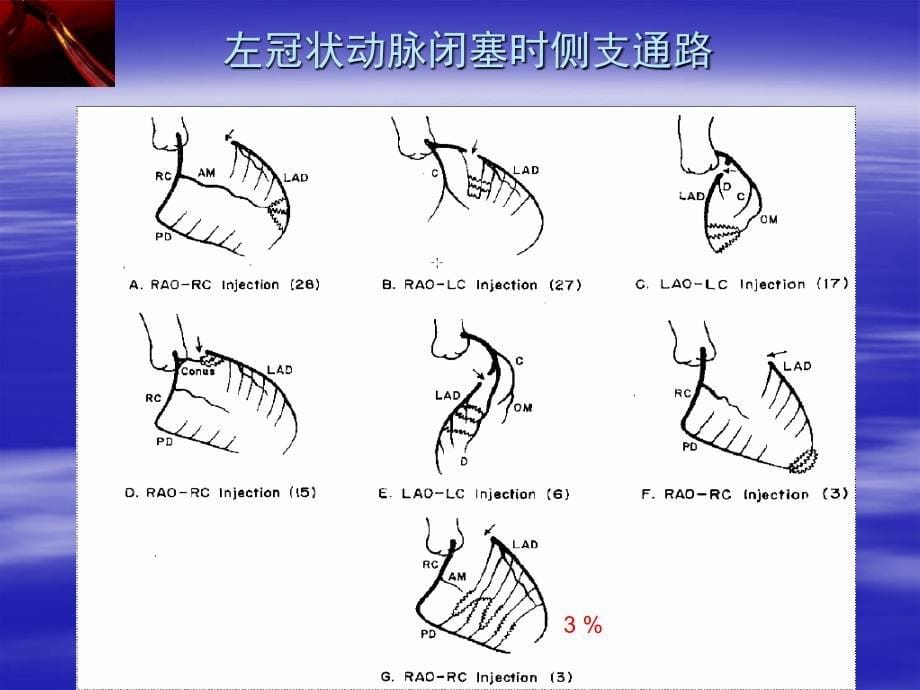 CTO侧支循环的解剖和生理学意义_第5页