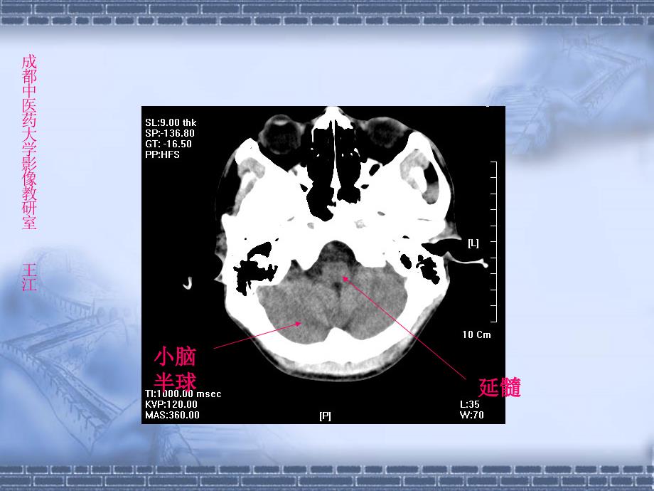 颅脑CT解剖_第3页