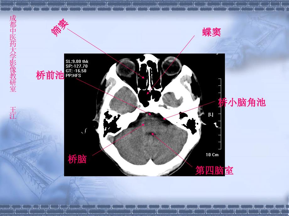 颅脑CT解剖_第4页
