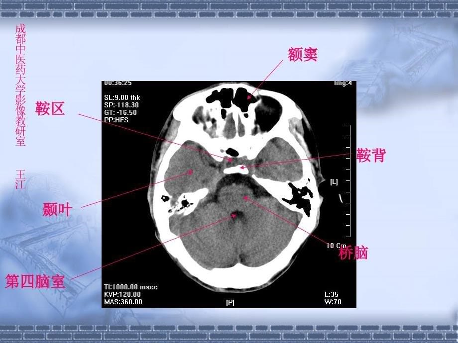 颅脑CT解剖_第5页