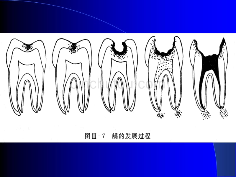 牙体牙髓病[新版]_第5页