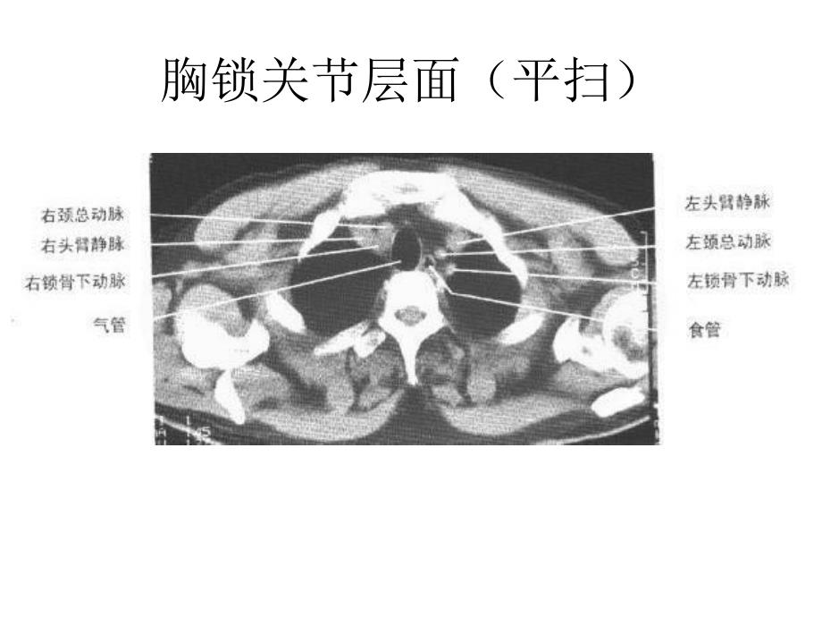 正常胸部纵隔窗CT解剖汇总_第2页