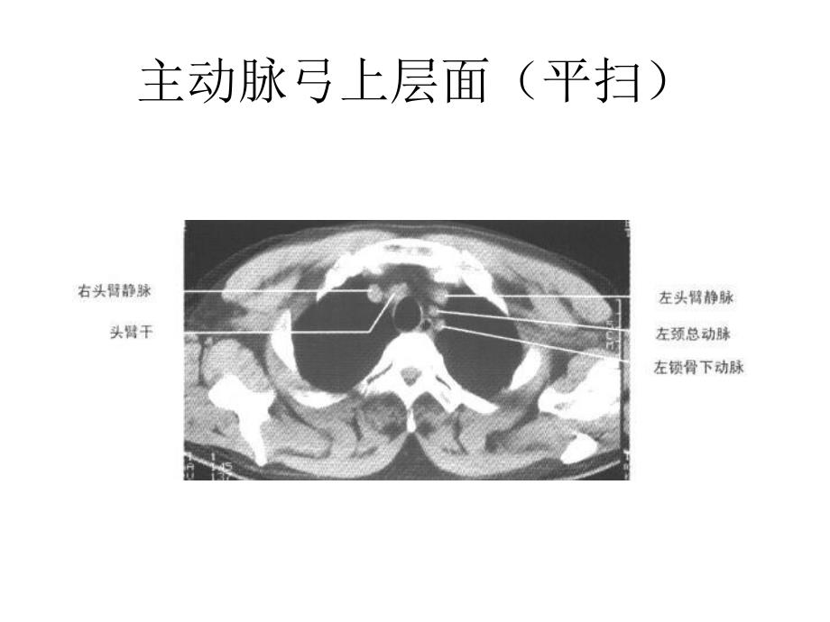 正常胸部纵隔窗CT解剖汇总_第4页