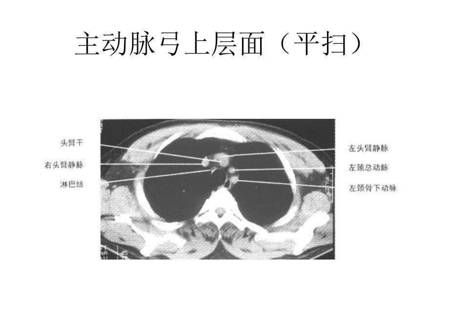 正常胸部纵隔窗CT解剖汇总_第5页