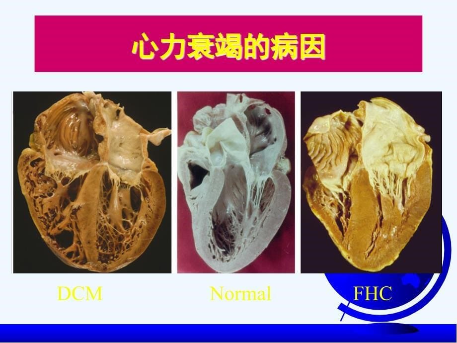 心力衰竭大课_第5页