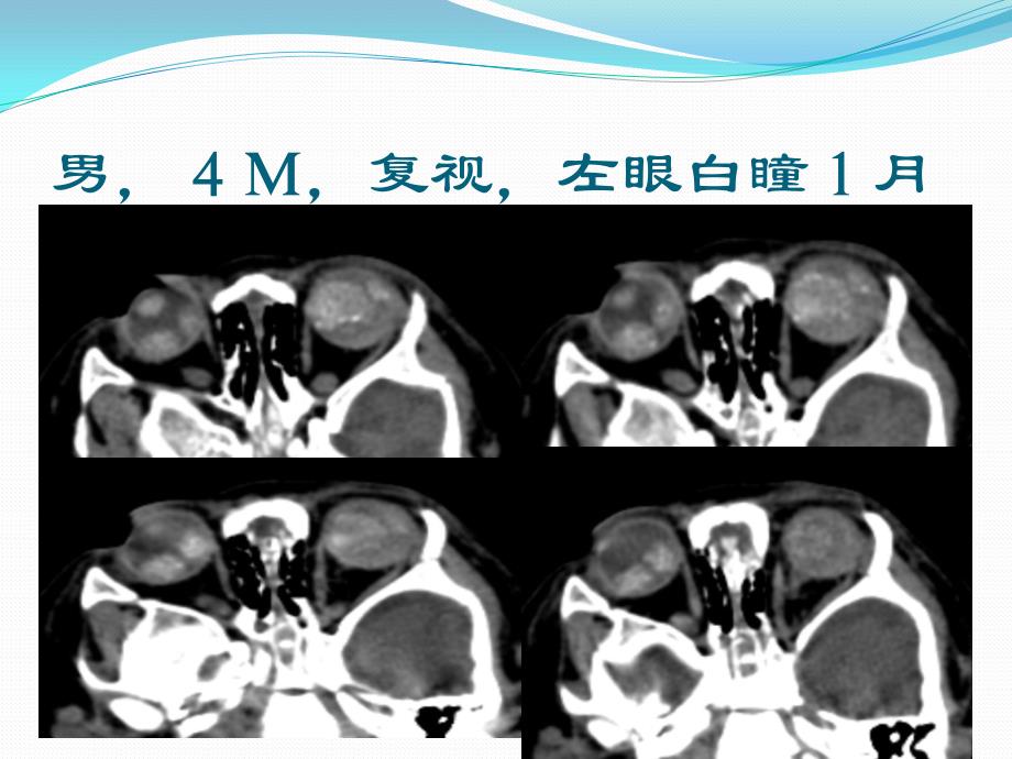 视网膜母细胞瘤的CT与MRI诊断 老骆驼._第2页