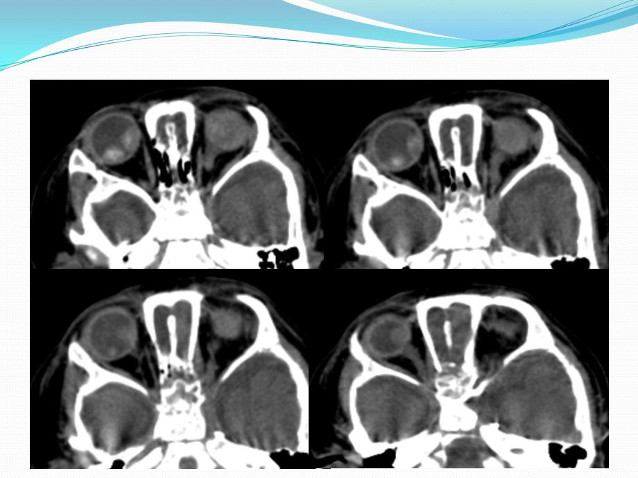 视网膜母细胞瘤的CT与MRI诊断 老骆驼._第3页