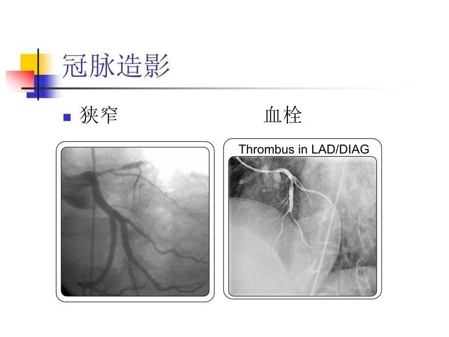 pci术前术中和术后_第5页