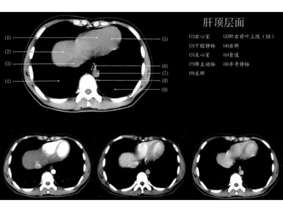 上腹部CT_各个层面._第2页