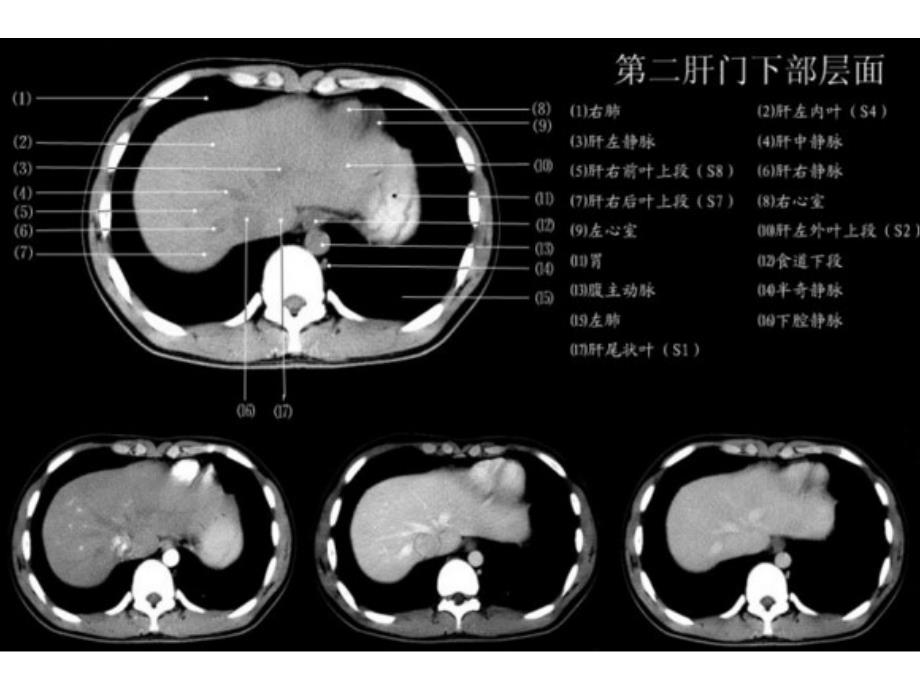 上腹部CT_各个层面._第4页