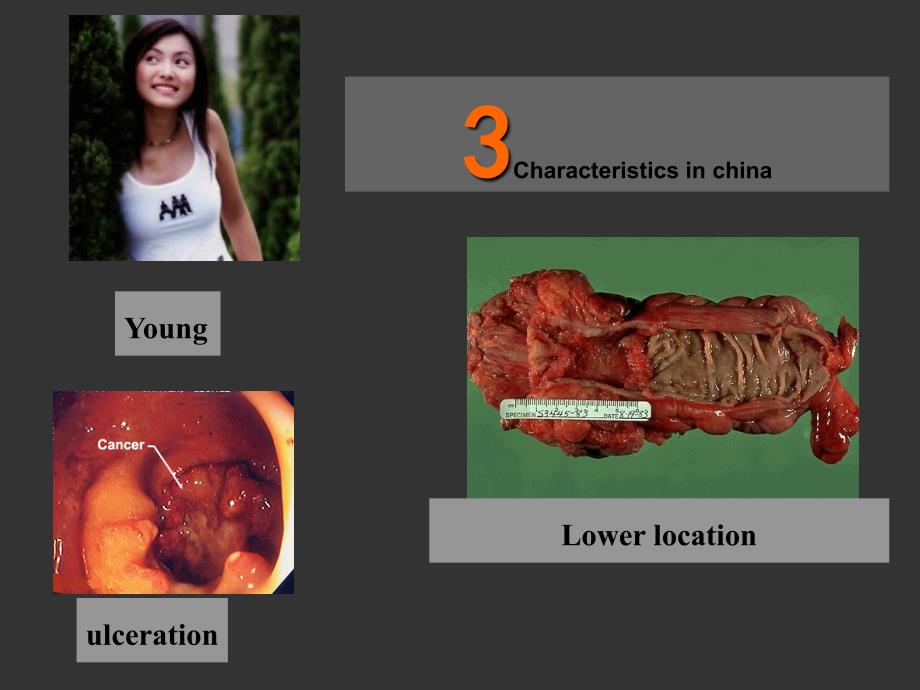 结直肠疾病英文课件_第3页