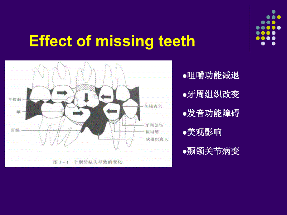 可摘局部义齿Removable Partial Prosthodontics_第2页