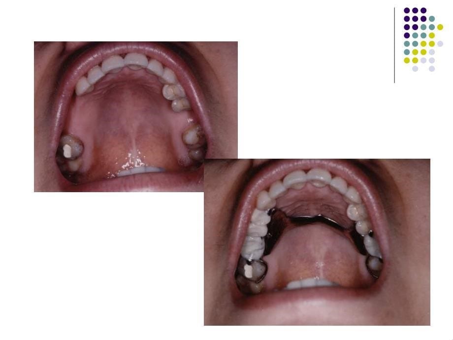 可摘局部义齿Removable Partial Prosthodontics_第5页