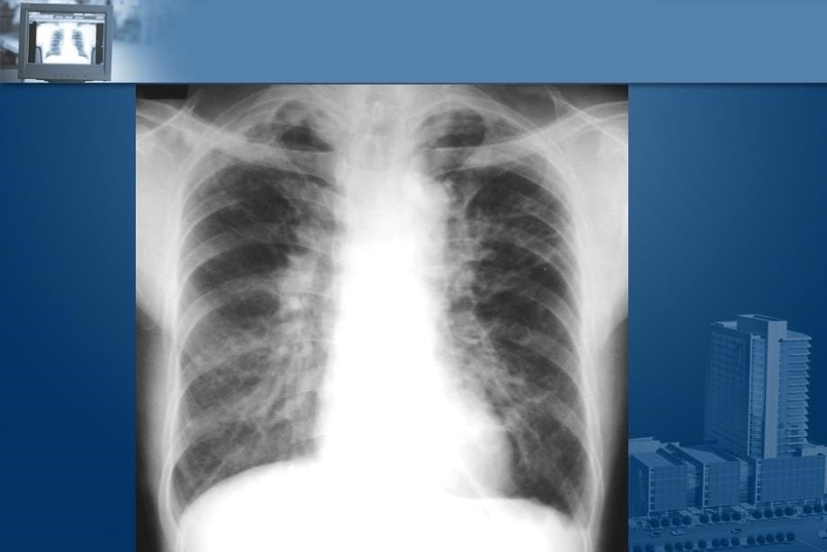 精品推荐医学影像诊断PPT课件图文详解完整版-呼吸系统影像学剖析_第5页