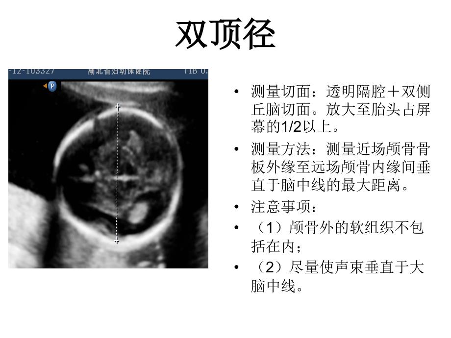 产科超声标准切面25张图._第1页