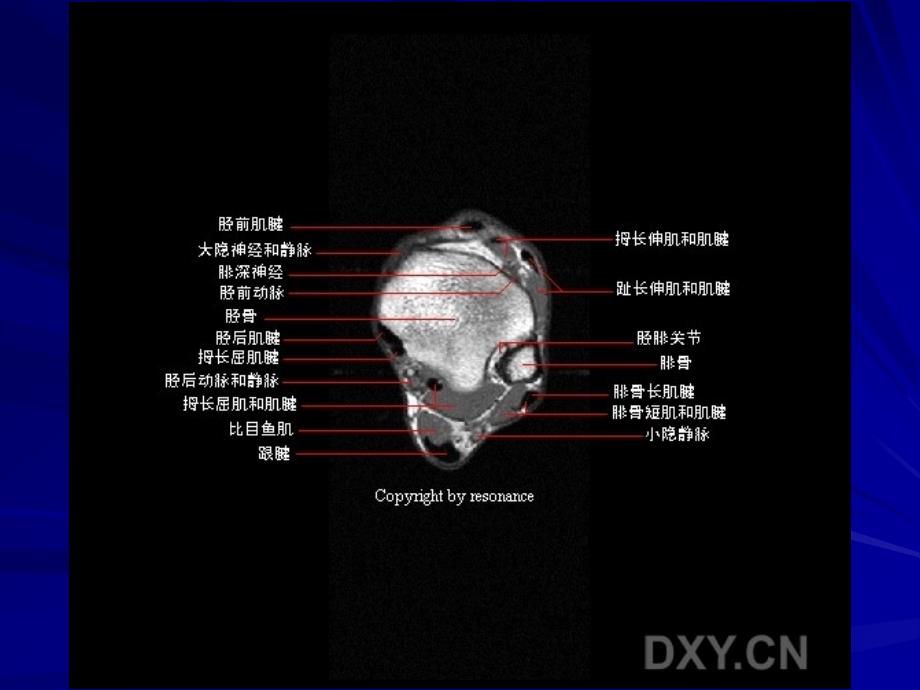 正常踝关节MR解剖资料_第3页