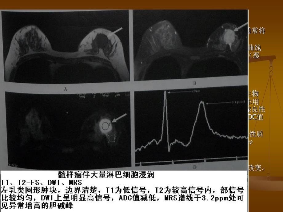 乳腺恶性病变的MRI讲解_第5页