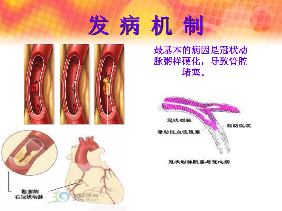 冠状动脉旁路移植术后护理_第4页