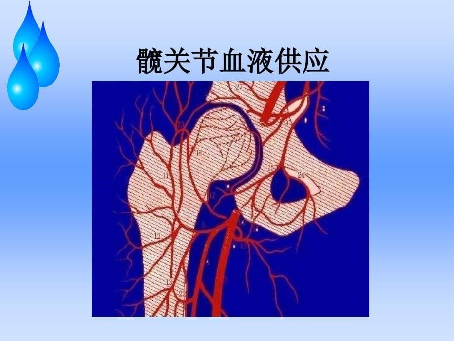 股骨头缺血性坏死护理查房剖析_第5页