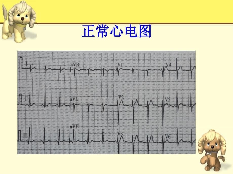 常见心律失常的心._第5页