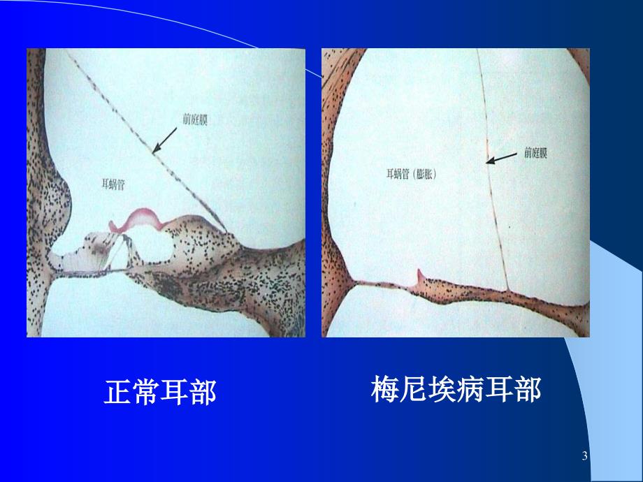 梅尼埃病及耳聋防治(2014)详解_第3页