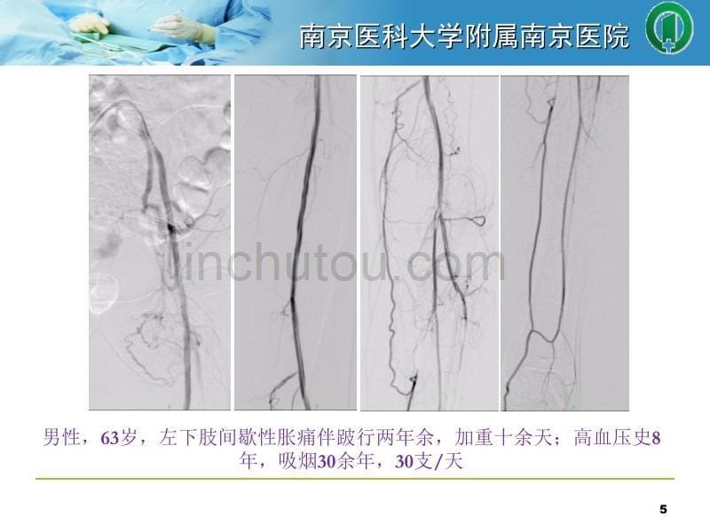 股腘动脉支架内再狭窄的介入处理综述_第5页