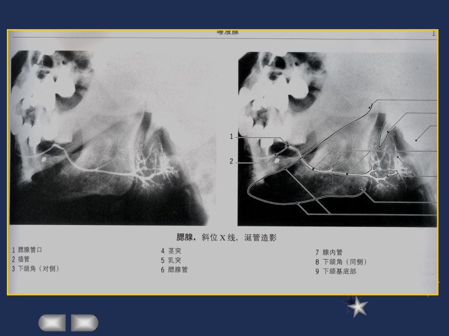 腮腺 颈部疾病影像诊断_第4页