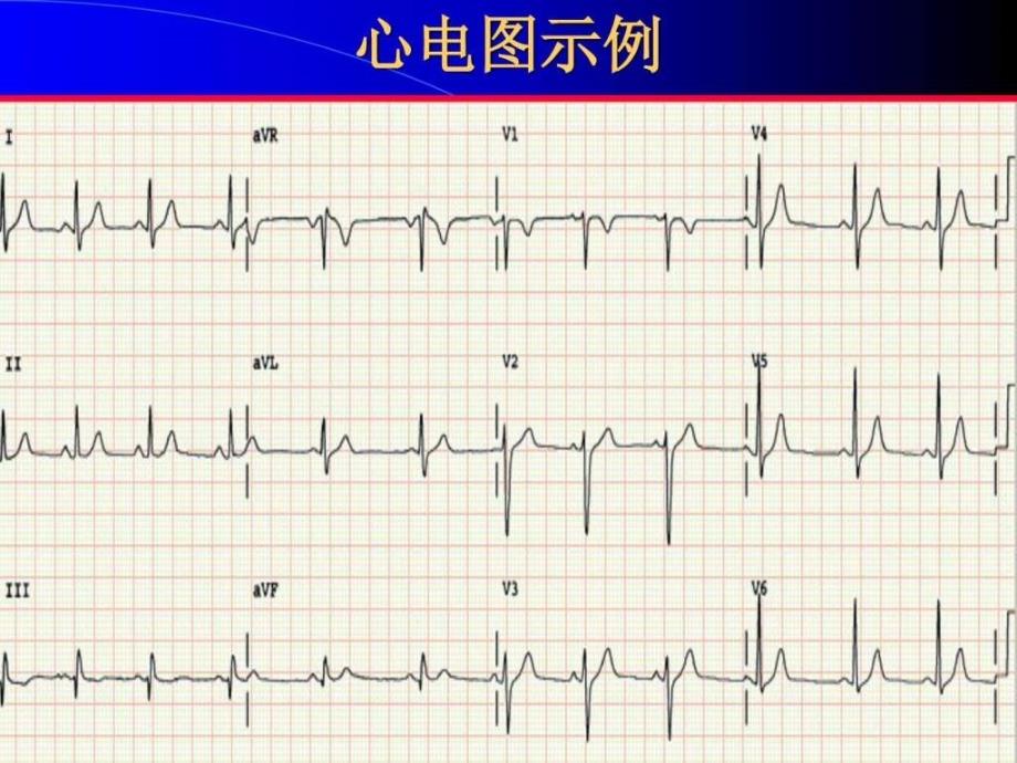 临床心电学基本知识汇总_第3页