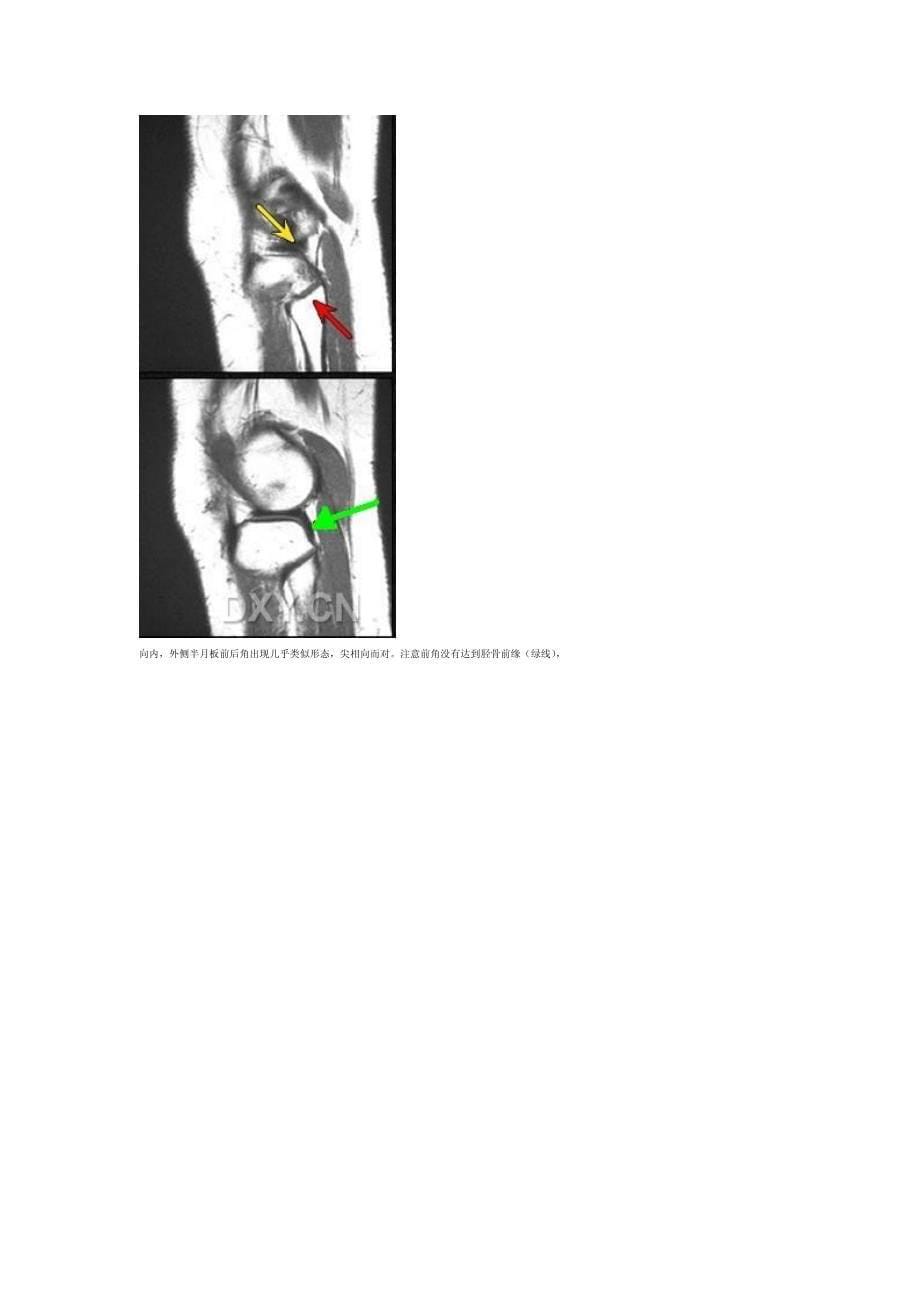 膝关节MRI诊断之正常解剖资料_第5页