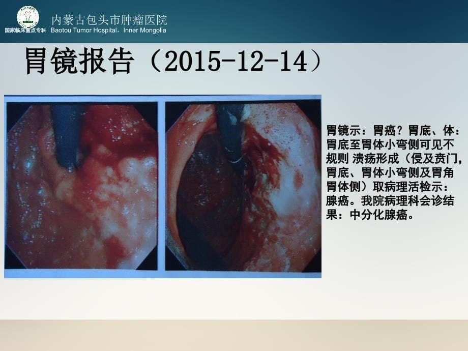 进展期胃癌多学科诊治_第5页