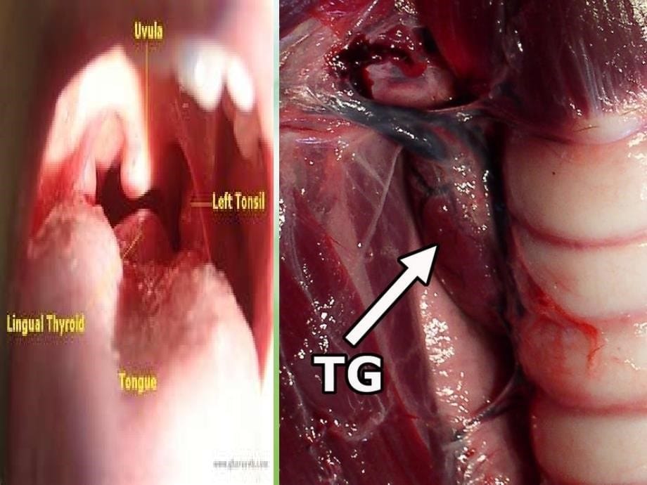 甲状腺围手术期护理资料_第5页