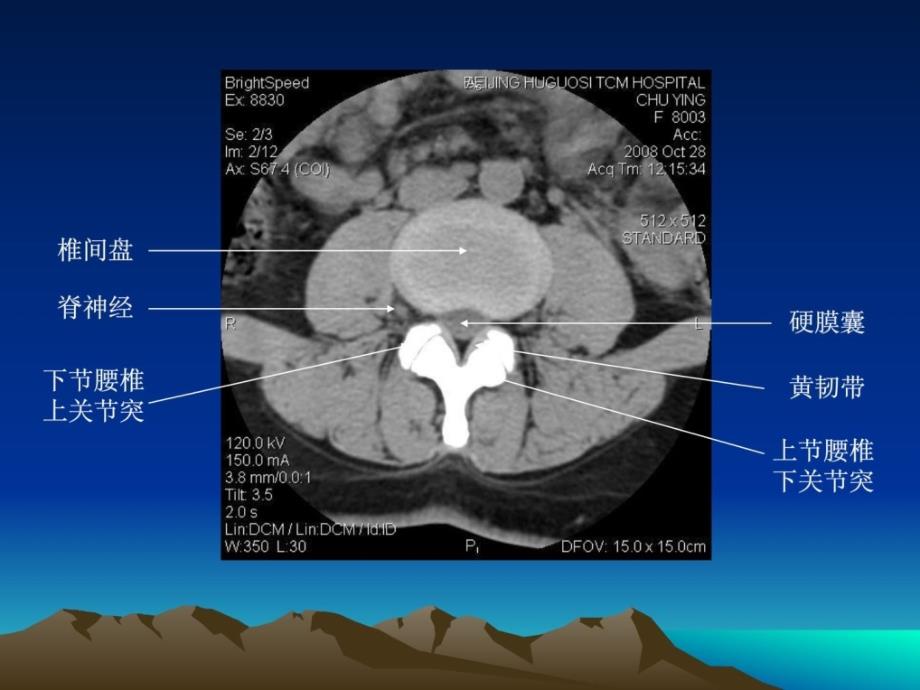 腰椎ct诊断[整理版]_第4页