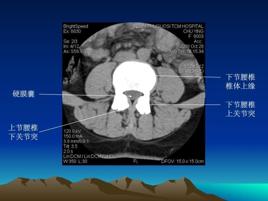 腰椎ct诊断[整理版]_第5页