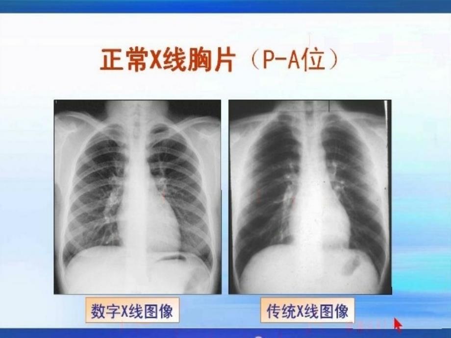 普通X线对胸部疾病的诊断作用（一）_第4页