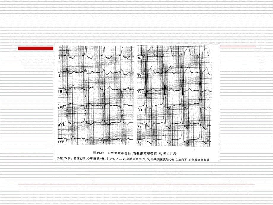 心电图疑难图谱_第5页