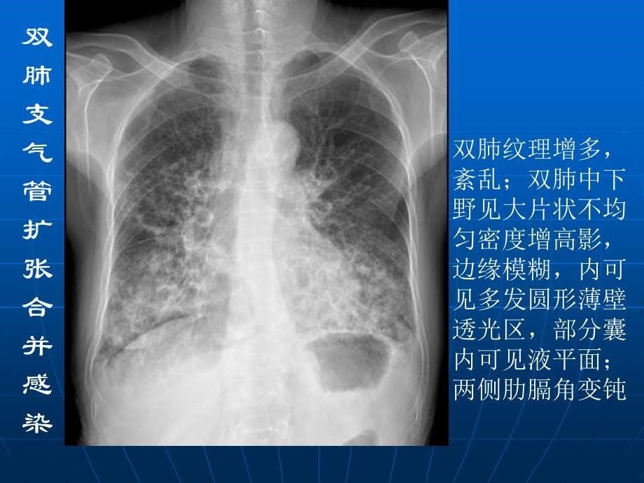 肺部感染性疾病的影像观察与分析讲解_第5页