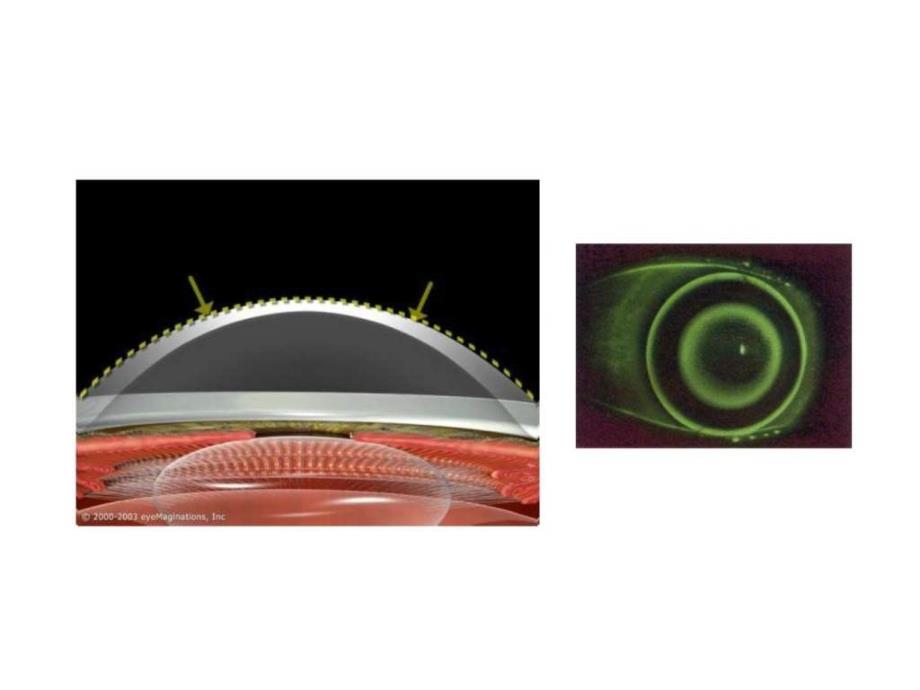 浅谈角膜塑形镜_图文._第4页
