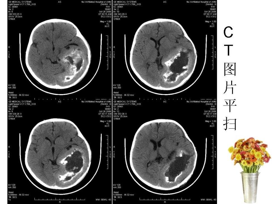 神经节细胞胶质瘤._第3页