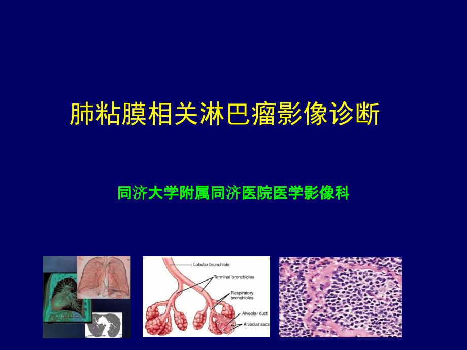 肺粘膜相关淋巴瘤影像特征讲解_第1页