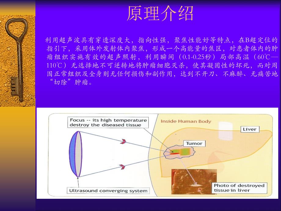 高强度聚焦超声肿瘤治疗系统介绍_第2页