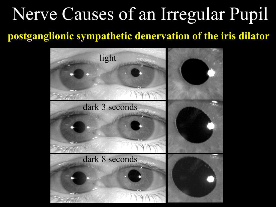 Fluorescein Video Angiography of the Ocular Circulation ：的荧光素血管造影眼部循环的视频_第4页