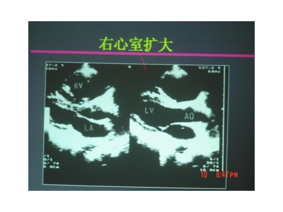 超声心动图在肺栓塞中应用 课件_第5页