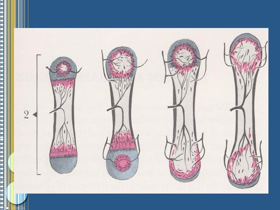 骨髓炎医学课件_第5页