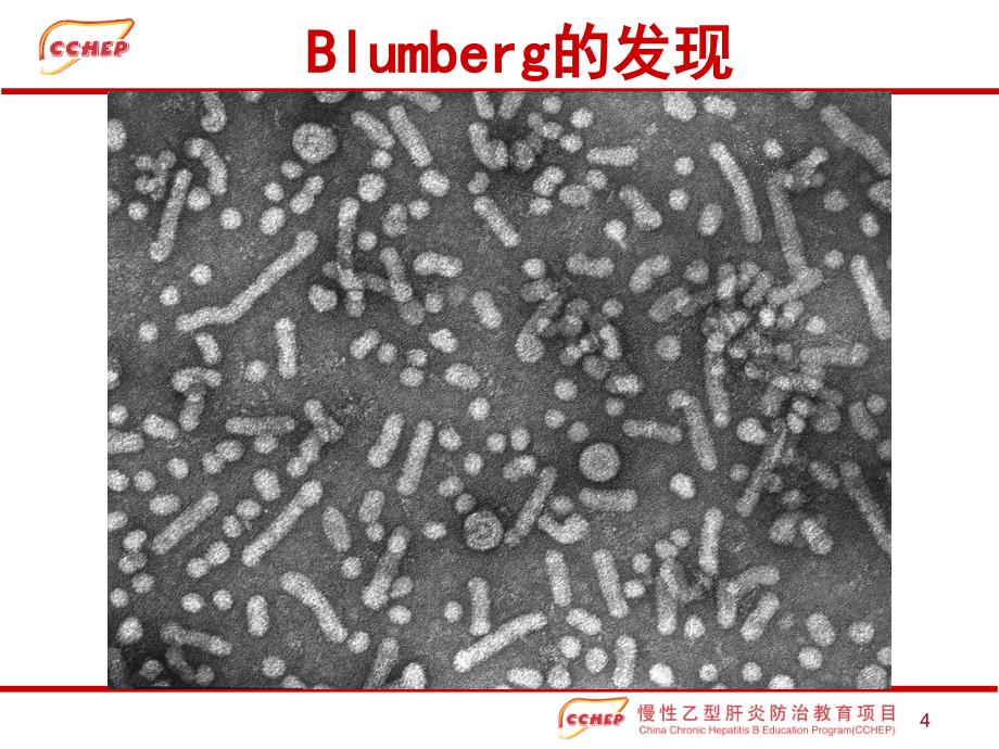 慢性乙型肝炎的诊断._第4页